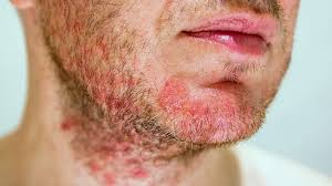 eczema