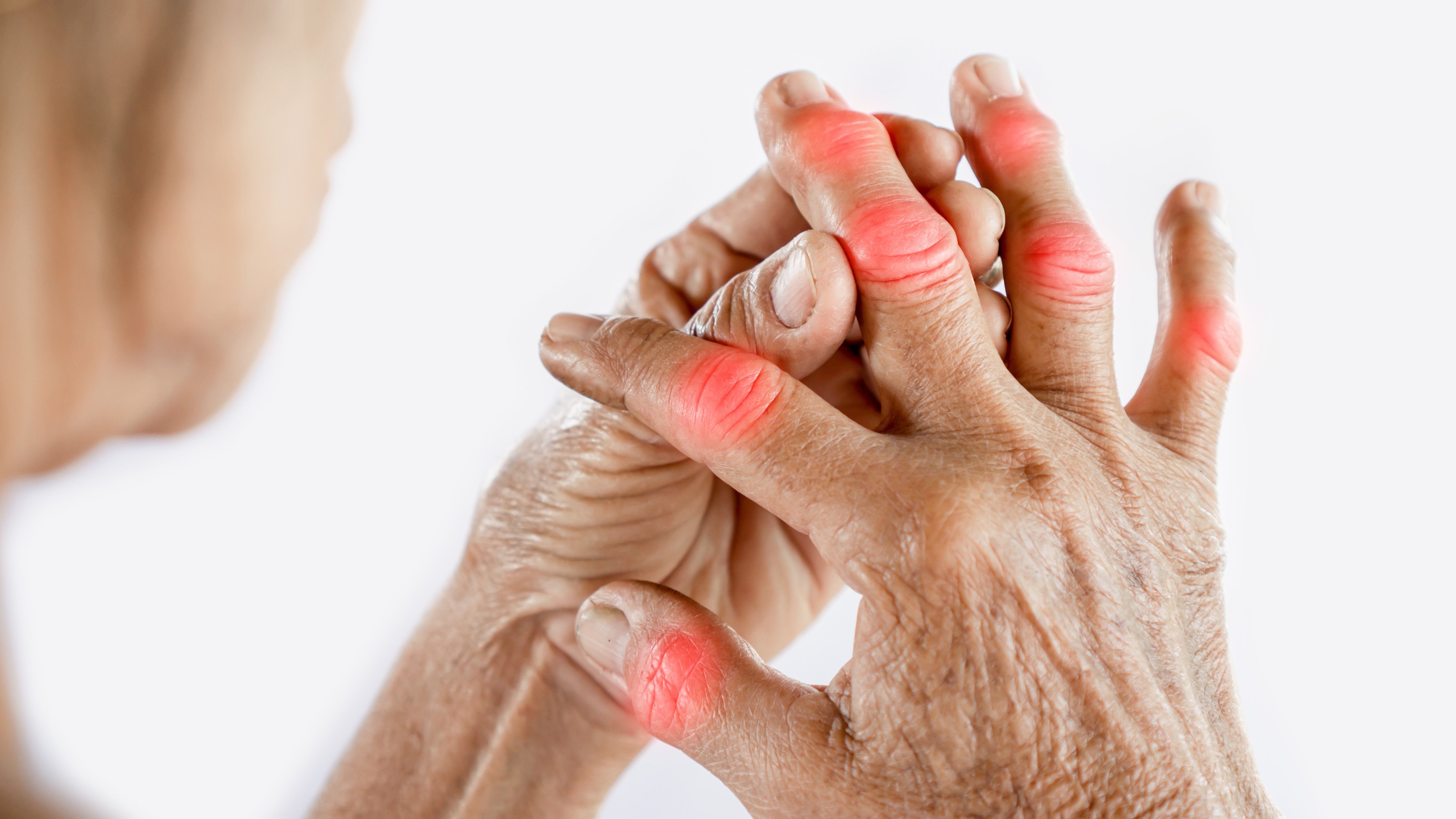 rheumatoid-arthritis